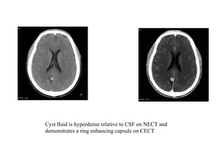 Cyst fluid is hyperdense relative to CSF on NECT and
demonstrates a ring enhancing capsule on CECT
 