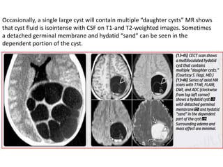 Occasionally, a single large cyst will contain multiple “daughter cysts” MR shows
that cyst fluid is isointense with CSF on T1-and T2-weighted images. Sometimes
a detached germinal membrane and hydatid “sand” can be seen in the
dependent portion of the cyst.
 