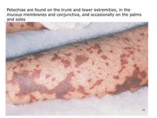 20
Petechiae are found on the trunk and lower extremities, in the
mucous membranes and conjunctiva, and occasionally on the palms
and soles
 