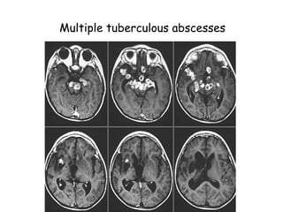 CNS Infections in human body and its management | PPTX