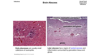 Comprehensive Overview of Central Nervous System Infections and ...