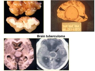 Comprehensive Overview of Central Nervous System Infections and ...