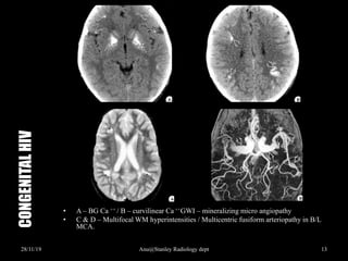 Cns Infections congenital, pyogenic & viral - Imaging | PPTX