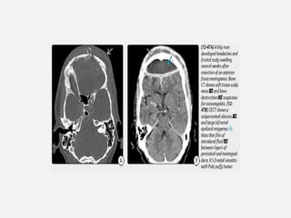CNS INFECTIONS IMAGING PART 1.......pptx