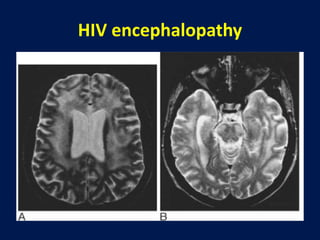 cnsinfectionsinhiv-1603189531138 (1).pptx