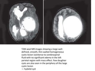 T2W axial MR images showing a large well-
defined, smooth, thin-walled homogeneous
cystic lesion isointense to cerebrospinal
fluid with no significant edema in the left
parietal region with mass effect. Few daughter
cysts are also seen in the periphery of the large
cystic lesion
— hydatid cyst
 
