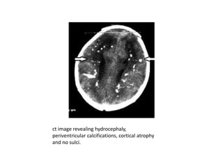 ct image revealing hydrocephaly,
periventricular calcifications, cortical atrophy
and no sulci.
 