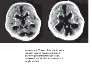 Non-contrast CT scans of the cranium of a
newborn showing hydrocephalus and
extensive periventricular calcification.
Also seen is calcification in bilateral basal
ganglia — CMV
 