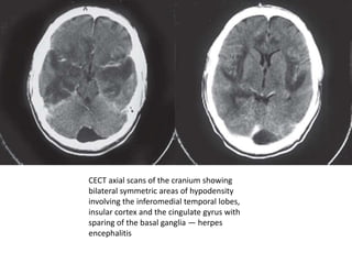 CECT axial scans of the cranium showing
bilateral symmetric areas of hypodensity
involving the inferomedial temporal lobes,
insular cortex and the cingulate gyrus with
sparing of the basal ganglia — herpes
encephalitis
 