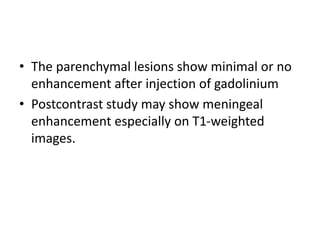• The parenchymal lesions show minimal or no
enhancement after injection of gadolinium
• Postcontrast study may show meningeal
enhancement especially on T1-weighted
images.
 