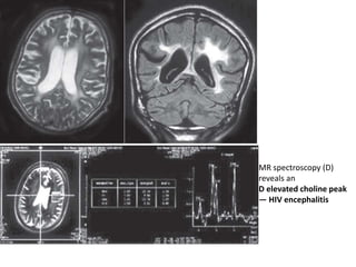 MR spectroscopy (D)
reveals an
D elevated choline peak
— HIV encephalitis
 