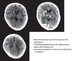 Noncontrast axial scan of the cranium (A)
showing an
ill-defined hypodensity in the right parietal
region with evidence of
postcontrast gyriform enhancement (B and C)
— cerebritis
 