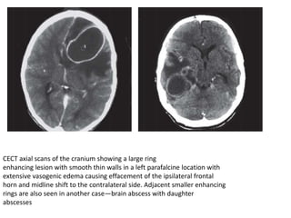 CECT axial scans of the cranium showing a large ring
enhancing lesion with smooth thin walls in a left parafalcine location with
extensive vasogenic edema causing effacement of the ipsilateral frontal
horn and midline shift to the contralateral side. Adjacent smaller enhancing
rings are also seen in another case—brain abscess with daughter
abscesses
 