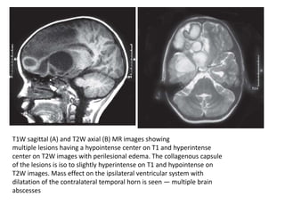 T1W sagittal (A) and T2W axial (B) MR images showing
multiple lesions having a hypointense center on T1 and hyperintense
center on T2W images with perilesional edema. The collagenous capsule
of the lesions is iso to slightly hyperintense on T1 and hypointense on
T2W images. Mass effect on the ipsilateral ventricular system with
dilatation of the contralateral temporal horn is seen — multiple brain
abscesses
 