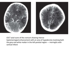 CECT axial scans of the cranium showing intense
leptomeningeal enhancement with an area of hypodensity involving both
the grey and white matter in the left parietal region — meningitis with
cortical infarct
 