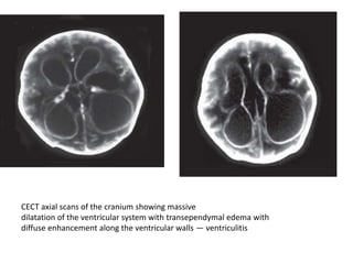 CECT axial scans of the cranium showing massive
dilatation of the ventricular system with transependymal edema with
diffuse enhancement along the ventricular walls — ventriculitis
 