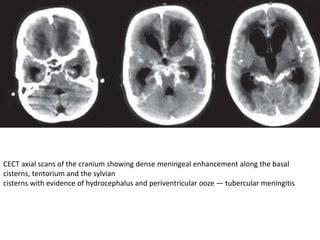 CECT axial scans of the cranium showing dense meningeal enhancement along the basal
cisterns, tentorium and the sylvian
cisterns with evidence of hydrocephalus and periventricular ooze — tubercular meningitis
 