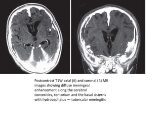 Postcontrast T1W axial (A) and coronal (B) MR
images showing diffuse meningeal
enhancement along the cerebral
convexities, tentorium and the basal cisterns
with hydrocephalus — tubercular meningitis
 