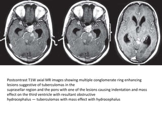 Postcontrast T1W axial MR images showing multiple conglomerate ring enhancing
lesions suggestive of tuberculomas in the
suprasellar region and the pons with one of the lesions causing indentation and mass
effect on the third ventricle with resultant obstructive
hydrocephalus — tuberculomas with mass effect with hydrocephalus
 