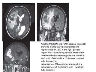 V
Axial T2W MR (A) and FLAIR Coronal image (B)
showing multiple conglomerate lesions
hypointense on T2W in the right parietal
region with surrounding edema. Mass effect
noted on the ipsilateral right lateral ventricle
with shift of the midline to the contralateral
side. On contrast
enhancement (C) conglomeration and ring
enhancement of the lesions seen—Multiple
tuberculomas.
 