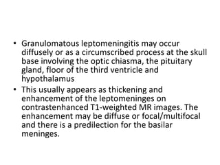 • Granulomatous leptomeningitis may occur
diffusely or as a circumscribed process at the skull
base involving the optic chiasma, the pituitary
gland, floor of the third ventricle and
hypothalamus
• This usually appears as thickening and
enhancement of the leptomeninges on
contrastenhanced T1-weighted MR images. The
enhancement may be diffuse or focal/multifocal
and there is a predilection for the basilar
meninges.
 