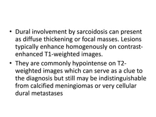 • Dural involvement by sarcoidosis can present
as diffuse thickening or focal masses. Lesions
typically enhance homogenously on contrast-
enhanced T1-weighted images.
• They are commonly hypointense on T2-
weighted images which can serve as a clue to
the diagnosis but still may be indistinguishable
from calcified meningiomas or very cellular
dural metastases
 