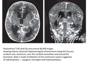 Postcontrast T1W axial (A) and coronal (B) MR images
showing intense abnormal leptomeningeal enhancement along the fissures,
cerebral sulci, tentorium, over the cerebral convexities and around the
brainstem. Note is made of dilatation of the ventricular system suggestive
of hydrocephalus — pyogenic meningitis with hydrocephalous
 