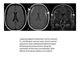 Leptomeningeal Involvement. (a) Pre-contrast
T1, and (b) post-contrast axial, and (c) coronal
sequences show widespread leptomeningeal
thickening and enhancement along the
convexities of the brain (arrowheads). Both
diffuse and nodular patterns are evident
 