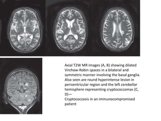 Axial T2W MR images (A, B) showing dilated
Virchow-Robin spaces in a bilateral and
symmetric manner involving the basal ganglia.
Also seen are round hyperintense lesion in
periventricular region and the left cerebellar
hemisphere representing cryptococcomas (C,
D)—
Cryptococcosis in an immunocompromised
patient
 