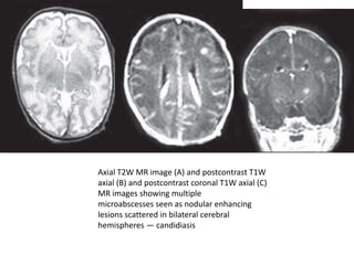 Axial T2W MR image (A) and postcontrast T1W
axial (B) and postcontrast coronal T1W axial (C)
MR images showing multiple
microabscesses seen as nodular enhancing
lesions scattered in bilateral cerebral
hemispheres — candidiasis
 