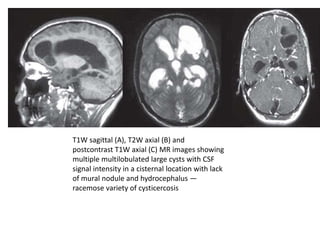 T1W sagittal (A), T2W axial (B) and
postcontrast T1W axial (C) MR images showing
multiple multilobulated large cysts with CSF
signal intensity in a cisternal location with lack
of mural nodule and hydrocephalus —
racemose variety of cysticercosis
 