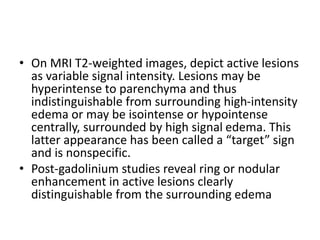 • On MRI T2-weighted images, depict active lesions
as variable signal intensity. Lesions may be
hyperintense to parenchyma and thus
indistinguishable from surrounding high-intensity
edema or may be isointense or hypointense
centrally, surrounded by high signal edema. This
latter appearance has been called a “target” sign
and is nonspecific.
• Post-gadolinium studies reveal ring or nodular
enhancement in active lesions clearly
distinguishable from the surrounding edema
 