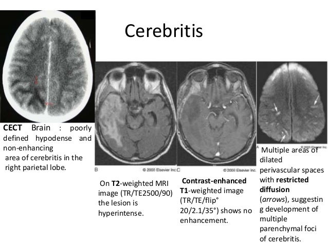 Featured image of post Cerebritis Ct Scan Cerebritis or myelitis develops with bacterial and fungal infections and may be secondary to meningitis penetrating injury or hematogeneous dissemination from systemic infection