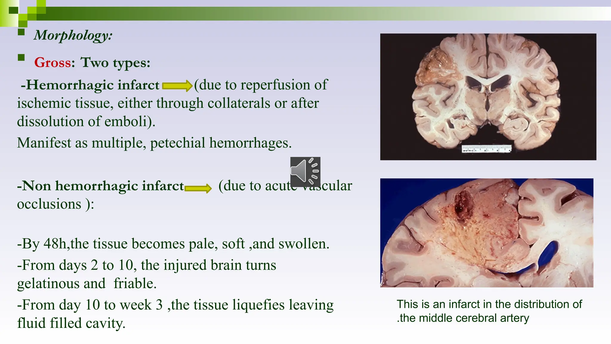  Morphology:
 Gross: Two types:
-Hemorrhagic infarct (due to reperfusion of
ischemic tissue, either through collaterals or after
dissolution of emboli).
Manifest as multiple, petechial hemorrhages.
-Non hemorrhagic infarct (due to acute vascular
occlusions ):
-By 48h,the tissue becomes pale, soft ,and swollen.
-From days 2 to 10, the injured brain turns
gelatinous and friable.
-From day 10 to week 3 ,the tissue liquefies leaving
fluid filled cavity.
This is an infarct in the distribution of
the middle cerebral artery
.
 