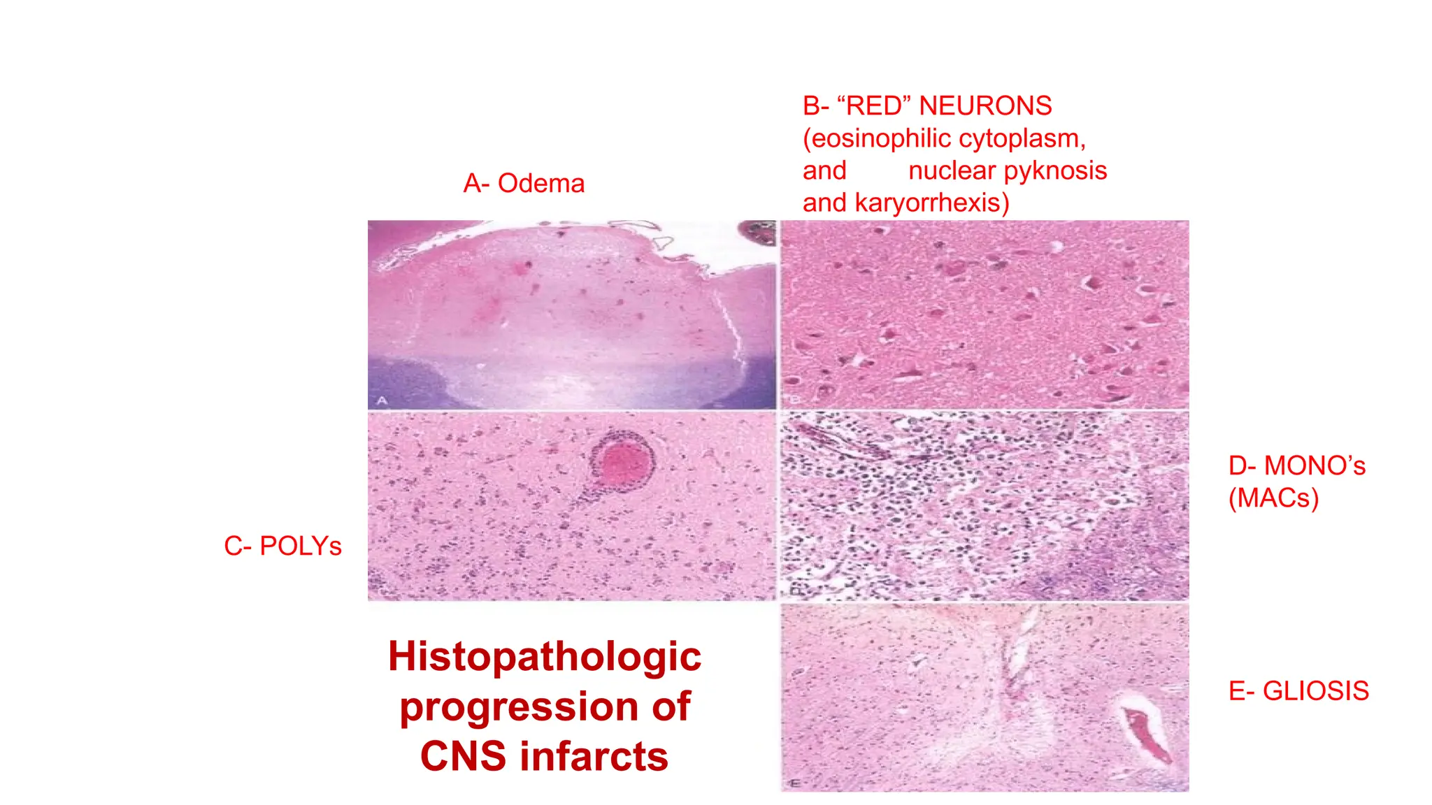 Histopathologic
progression of
CNS infarcts
B- “RED” NEURONS
(eosinophilic cytoplasm,
and nuclear pyknosis
and karyorrhexis)
D- MONO’s
(MACs)
E- GLIOSIS
A- Odema
C- POLYs
 