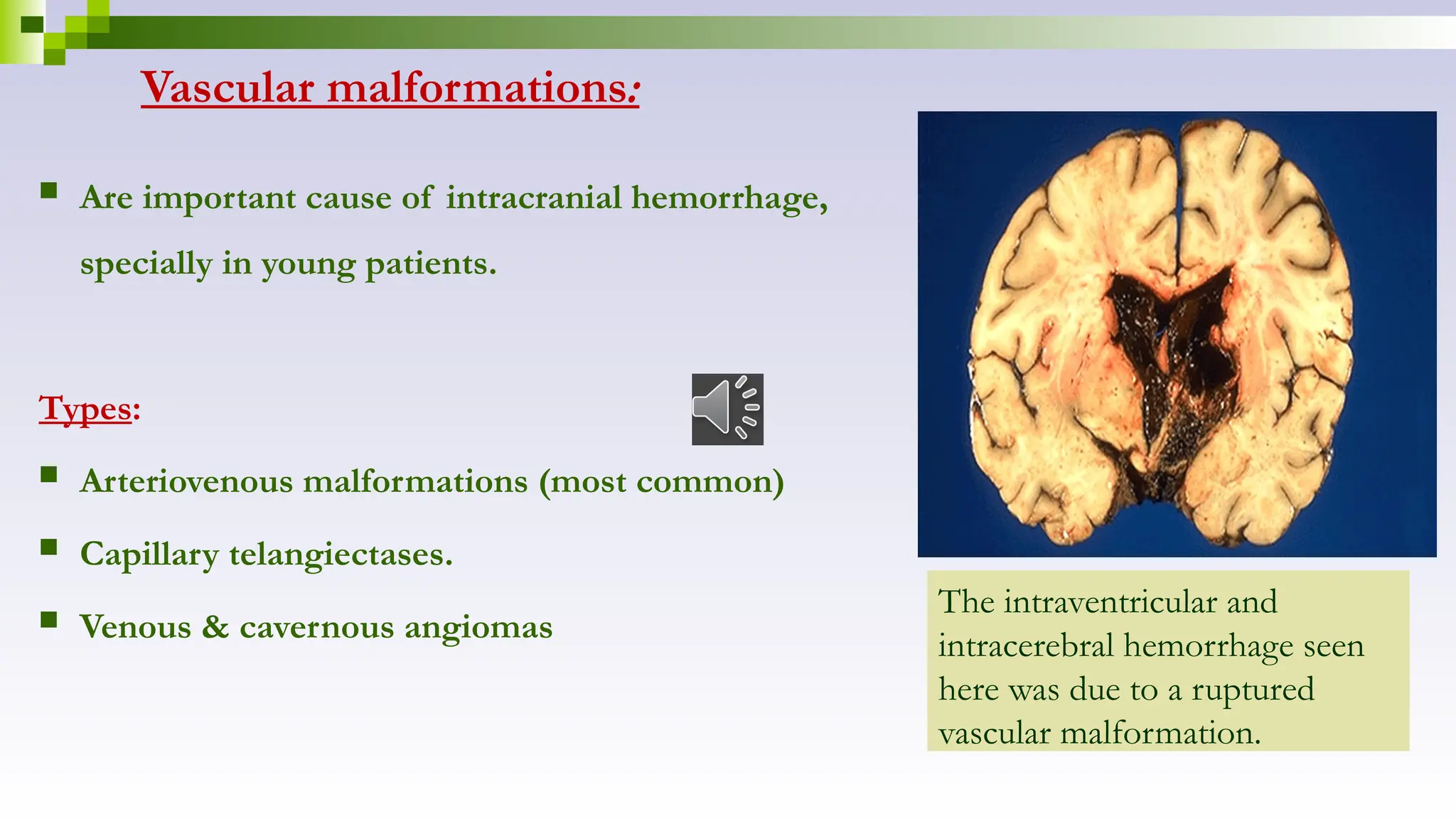 Vascular malformations:
 Are important cause of intracranial hemorrhage,
specially in young patients.
Types:
 Arteriovenous malformations (most common)
 Capillary telangiectases.
 Venous & cavernous angiomas
The intraventricular and
intracerebral hemorrhage seen
here was due to a ruptured
vascular malformation.
 