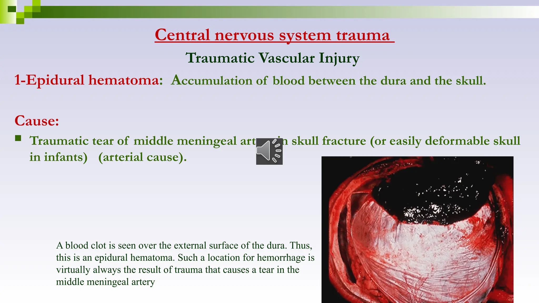 Central nervous system trauma
Traumatic Vascular Injury
1-Epidural hematoma: Accumulation of blood between the dura and the skull.
Cause:
 Traumatic tear of middle meningeal artery in skull fracture (or easily deformable skull
in infants) (arterial cause).
A blood clot is seen over the external surface of the dura. Thus,
this is an epidural hematoma. Such a location for hemorrhage is
virtually always the result of trauma that causes a tear in the
middle meningeal artery
 