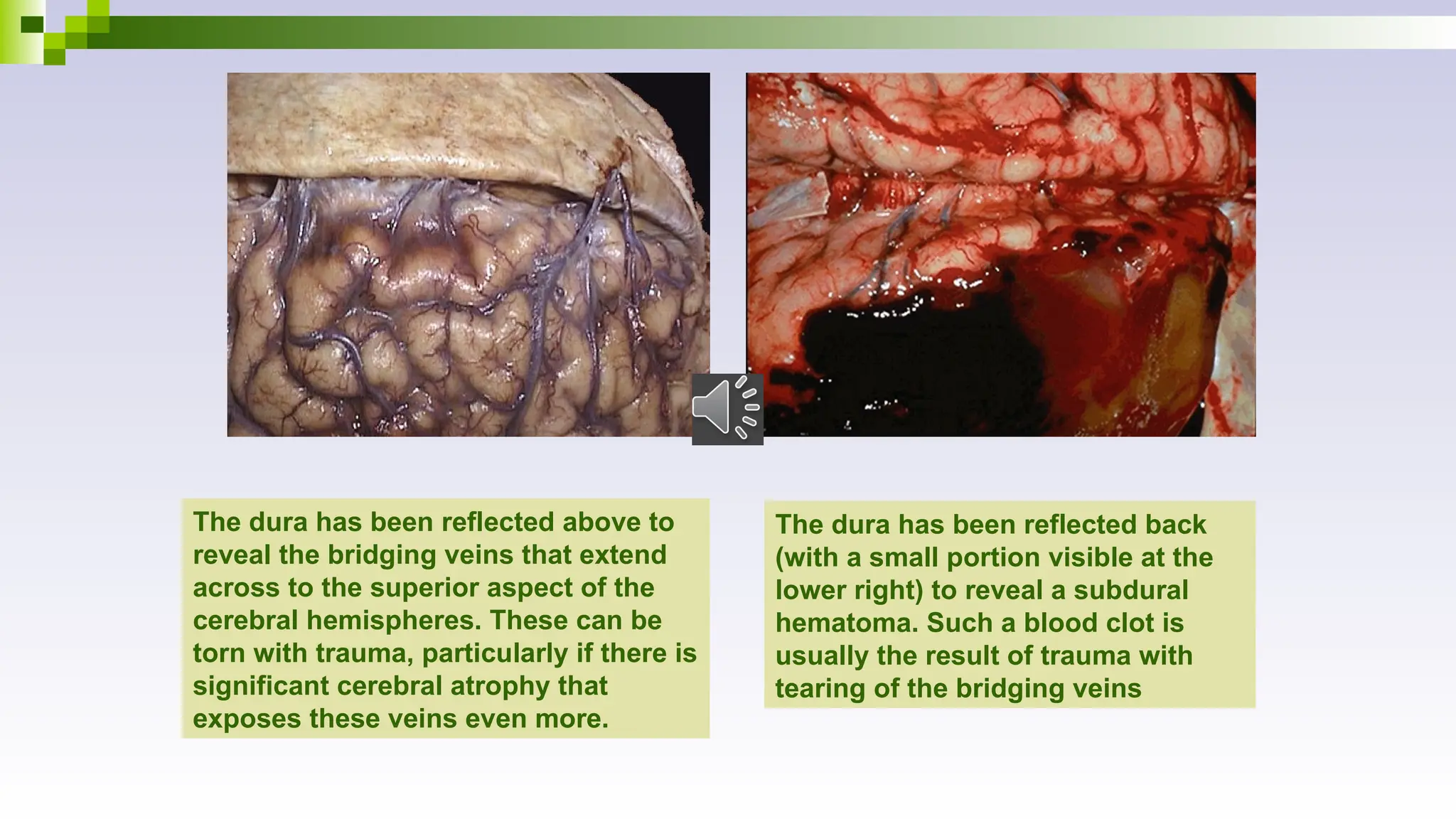 The dura has been reflected above to
reveal the bridging veins that extend
across to the superior aspect of the
cerebral hemispheres. These can be
torn with trauma, particularly if there is
significant cerebral atrophy that
exposes these veins even more.
The dura has been reflected back
(with a small portion visible at the
lower right) to reveal a subdural
hematoma. Such a blood clot is
usually the result of trauma with
tearing of the bridging veins
 