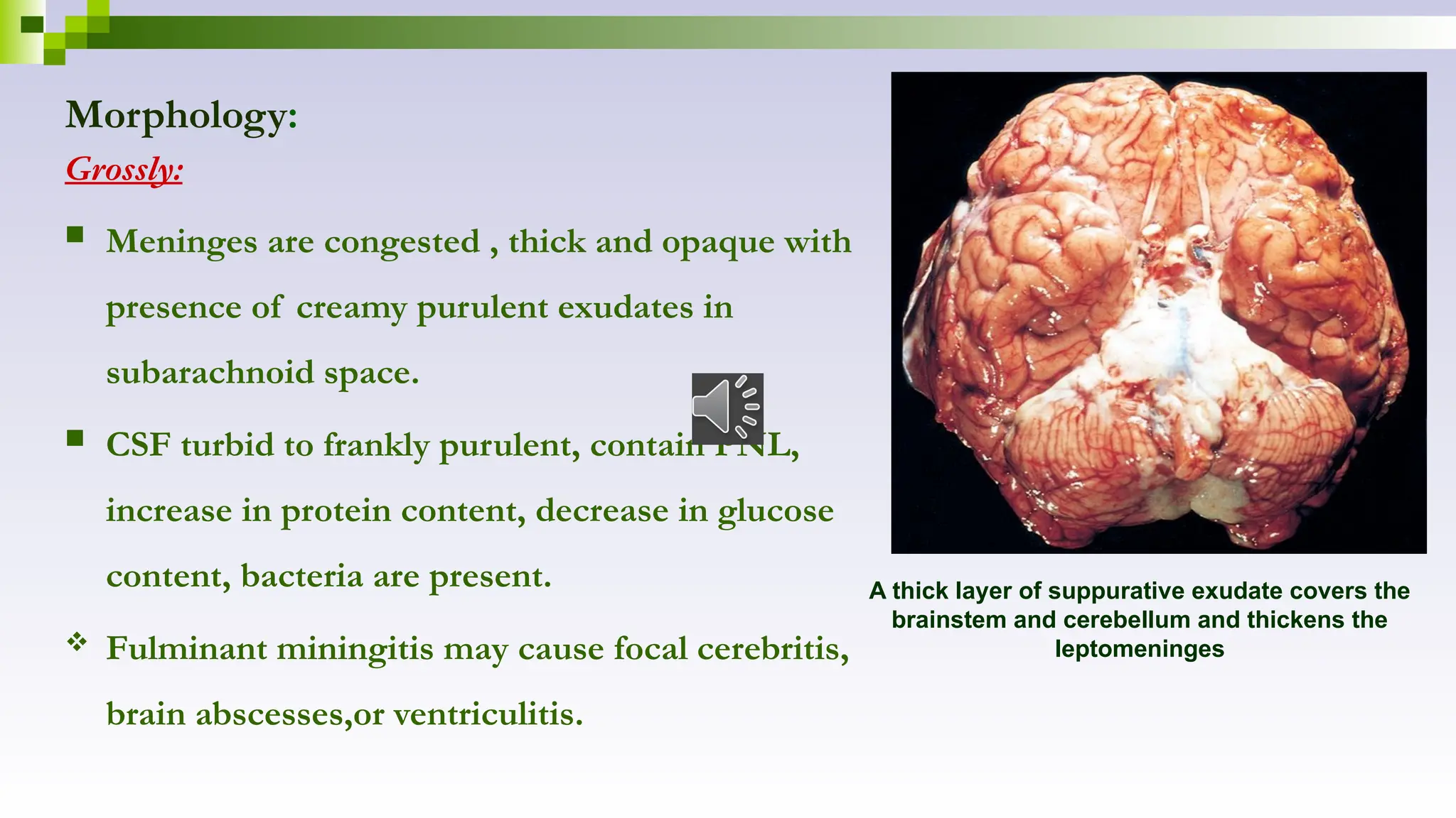 Morphology:
Grossly:
 Meninges are congested , thick and opaque with
presence of creamy purulent exudates in
subarachnoid space.
 CSF turbid to frankly purulent, contain PNL,
increase in protein content, decrease in glucose
content, bacteria are present.
 Fulminant miningitis may cause focal cerebritis,
brain abscesses,or ventriculitis.
A thick layer of suppurative exudate covers the
brainstem and cerebellum and thickens the
leptomeninges
 
