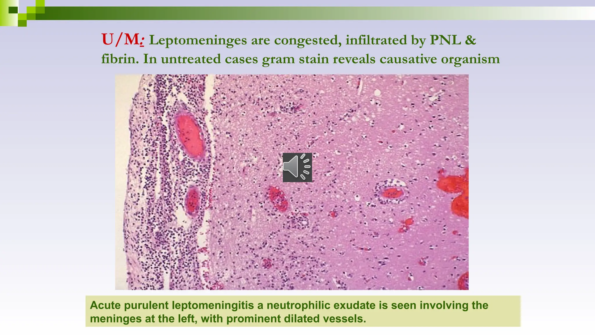 U/M: Leptomeninges are congested, infiltrated by PNL &
fibrin. In untreated cases gram stain reveals causative organism
Acute purulent leptomeningitis a neutrophilic exudate is seen involving the
meninges at the left, with prominent dilated vessels.
 