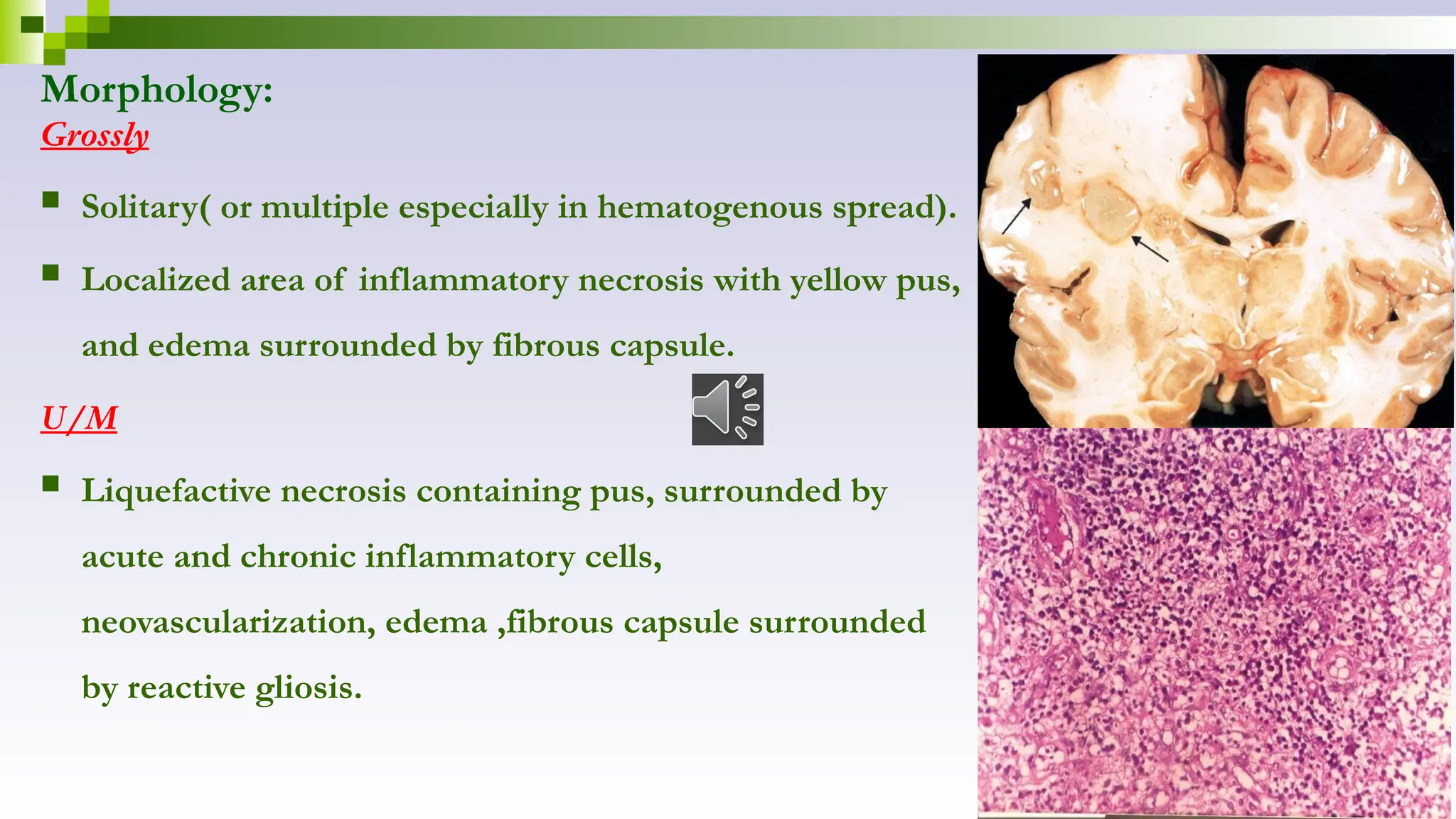 Morphology:
Grossly
 Solitary( or multiple especially in hematogenous spread).
 Localized area of inflammatory necrosis with yellow pus,
and edema surrounded by fibrous capsule.
U/M
 Liquefactive necrosis containing pus, surrounded by
acute and chronic inflammatory cells,
neovascularization, edema ,fibrous capsule surrounded
by reactive gliosis.
 