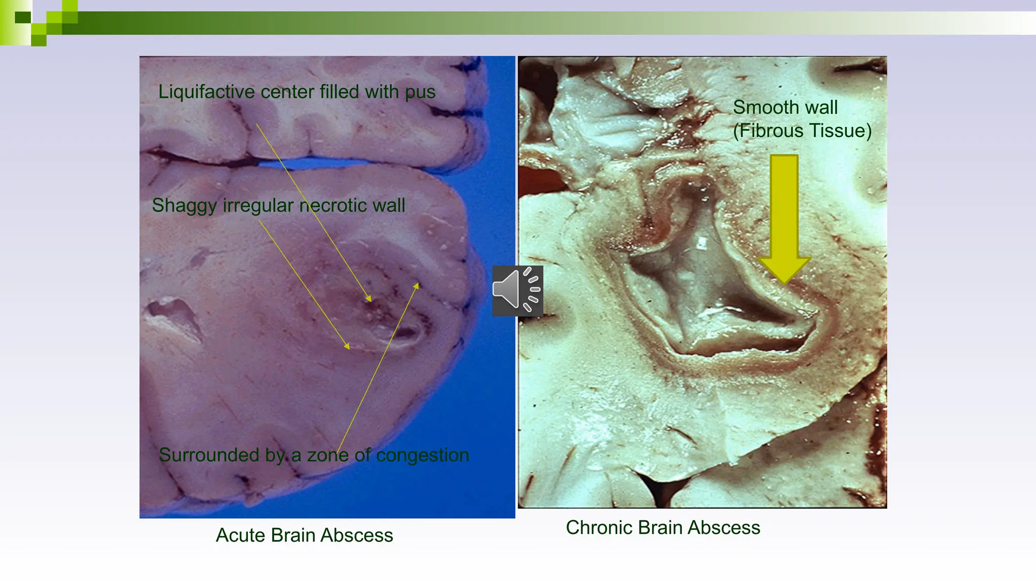 Chronic Brain Abscess
Smooth wall
(Fibrous Tissue)
Acute Brain Abscess
Liquifactive center filled with pus
Shaggy irregular necrotic wall
Surrounded by a zone of congestion
 