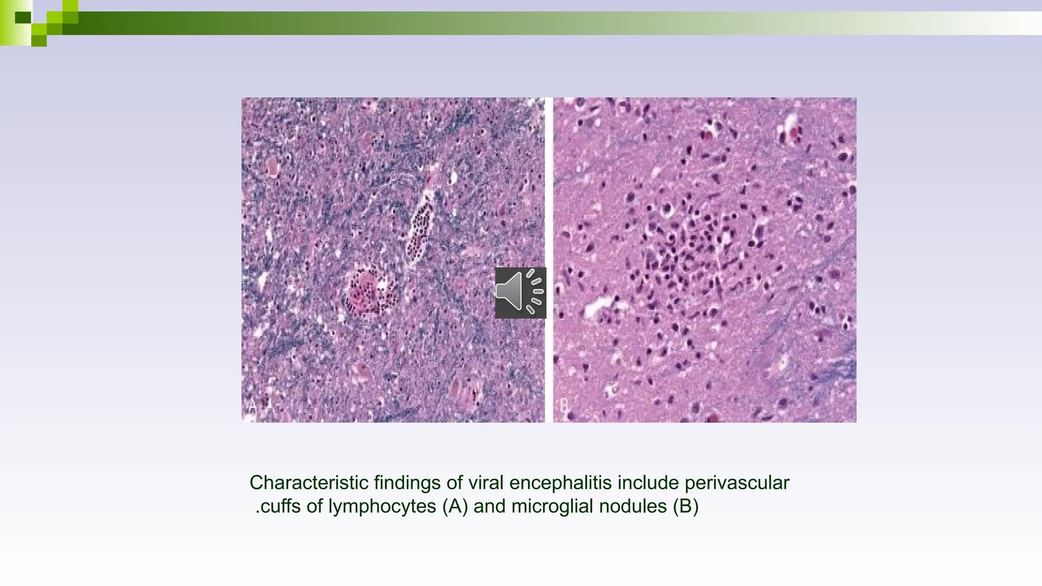 Characteristic findings of viral encephalitis include perivascular
cuffs of lymphocytes (A) and microglial nodules (B)
.
 