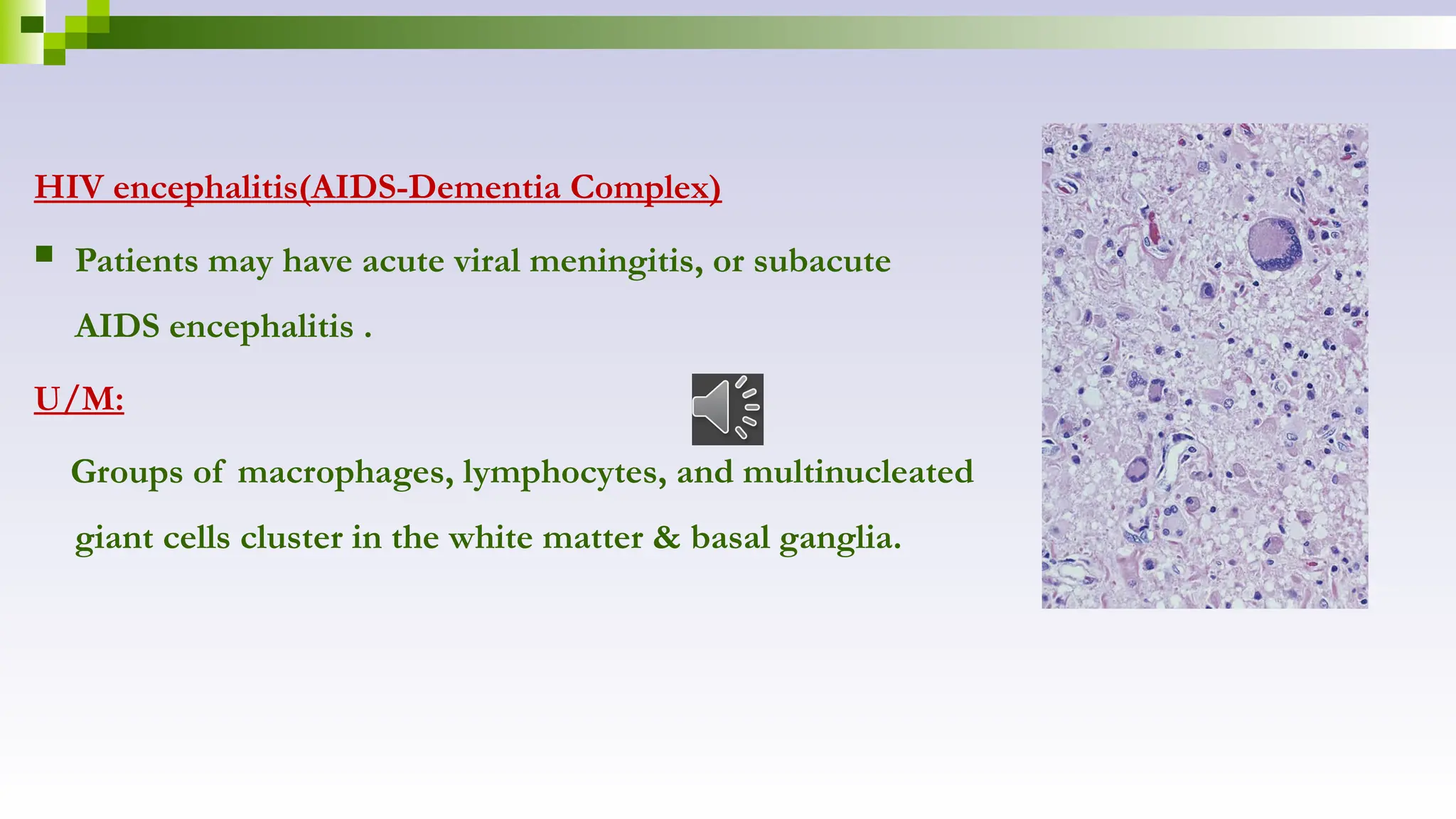 HIV encephalitis(AIDS-Dementia Complex)
 Patients may have acute viral meningitis, or subacute
AIDS encephalitis .
U/M:
Groups of macrophages, lymphocytes, and multinucleated
giant cells cluster in the white matter & basal ganglia.
 