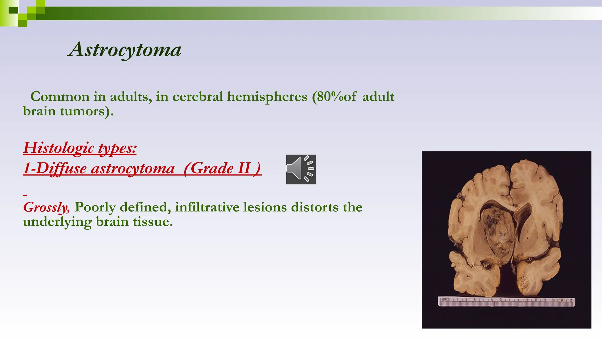 Astrocytoma
Common in adults, in cerebral hemispheres (80%of adult
brain tumors).
Histologic types:
1-Diffuse astrocytoma (Grade II )
Grossly, Poorly defined, infiltrative lesions distorts the
underlying brain tissue.
 