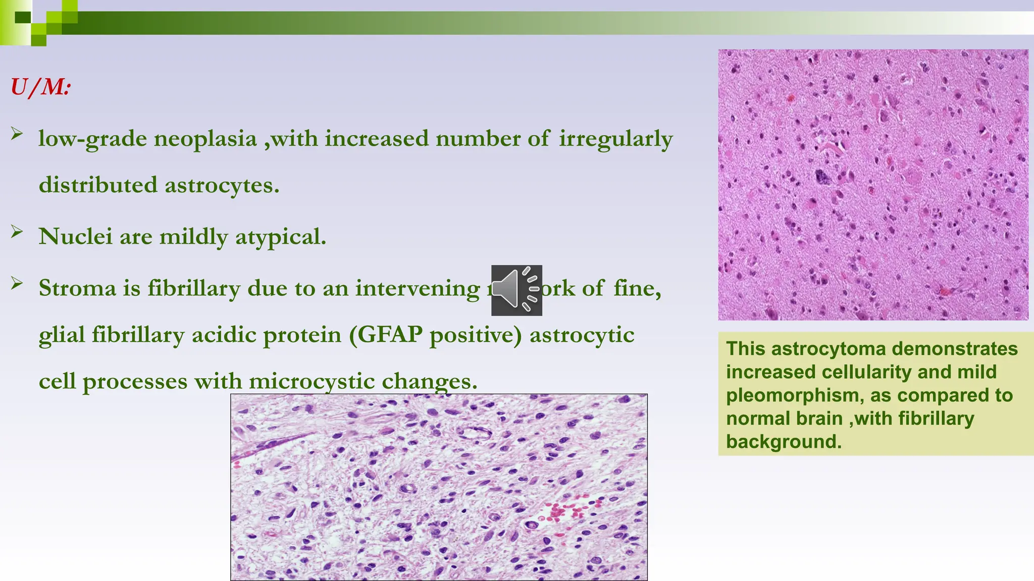 U/M:
 low-grade neoplasia ,with increased number of irregularly
distributed astrocytes.
 Nuclei are mildly atypical.
 Stroma is fibrillary due to an intervening network of fine,
glial fibrillary acidic protein (GFAP positive) astrocytic
cell processes with microcystic changes.
This astrocytoma demonstrates
increased cellularity and mild
pleomorphism, as compared to
normal brain ,with fibrillary
background.
 