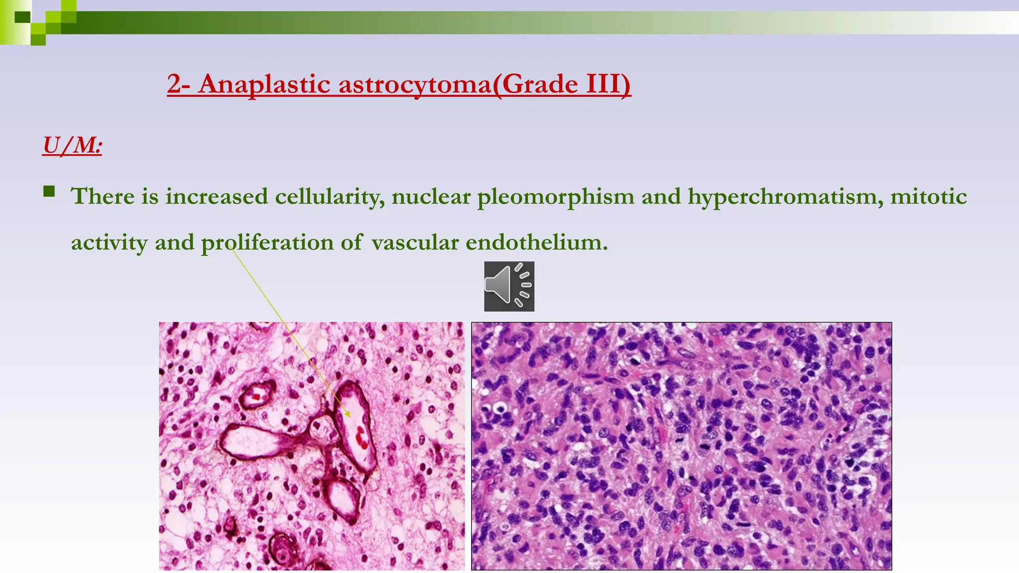 2- Anaplastic astrocytoma(Grade III)
U/M:
 There is increased cellularity, nuclear pleomorphism and hyperchromatism, mitotic
activity and proliferation of vascular endothelium.
 