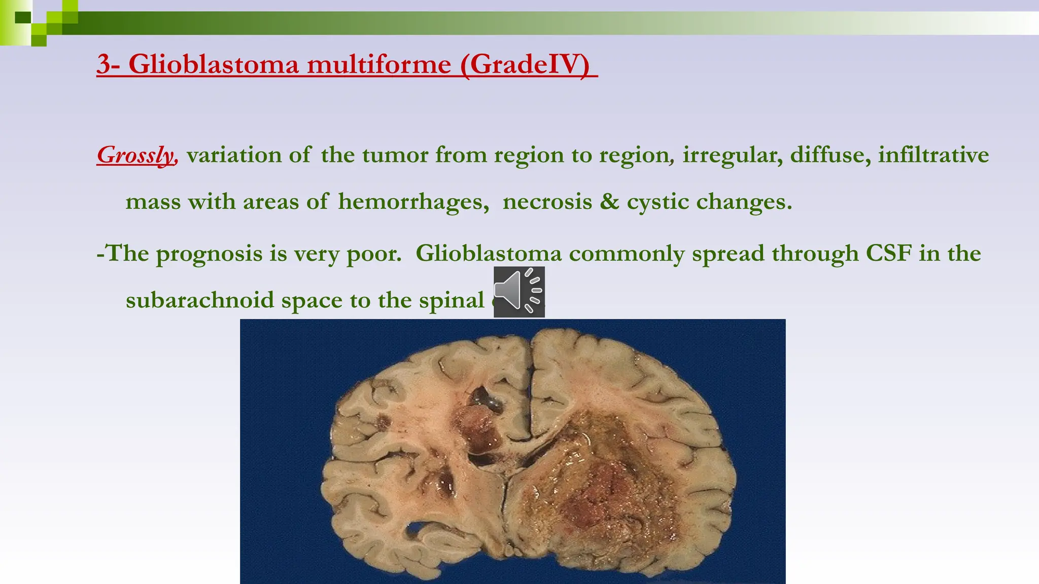 3- Glioblastoma multiforme (GradeIV)
Grossly, variation of the tumor from region to region, irregular, diffuse, infiltrative
mass with areas of hemorrhages, necrosis & cystic changes.
-The prognosis is very poor. Glioblastoma commonly spread through CSF in the
subarachnoid space to the spinal cord.
 