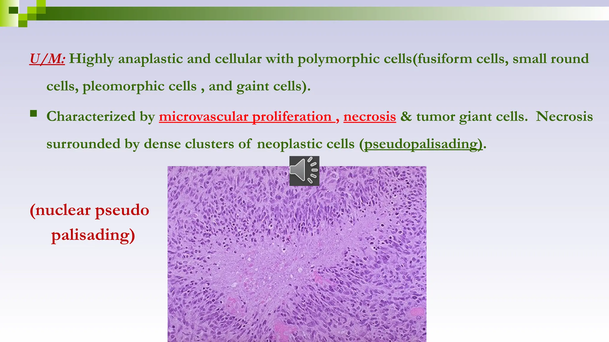 U/M: Highly anaplastic and cellular with polymorphic cells(fusiform cells, small round
cells, pleomorphic cells , and gaint cells).
 Characterized by microvascular proliferation , necrosis & tumor giant cells. Necrosis
surrounded by dense clusters of neoplastic cells (pseudopalisading).
(nuclear pseudo
palisading)
 
