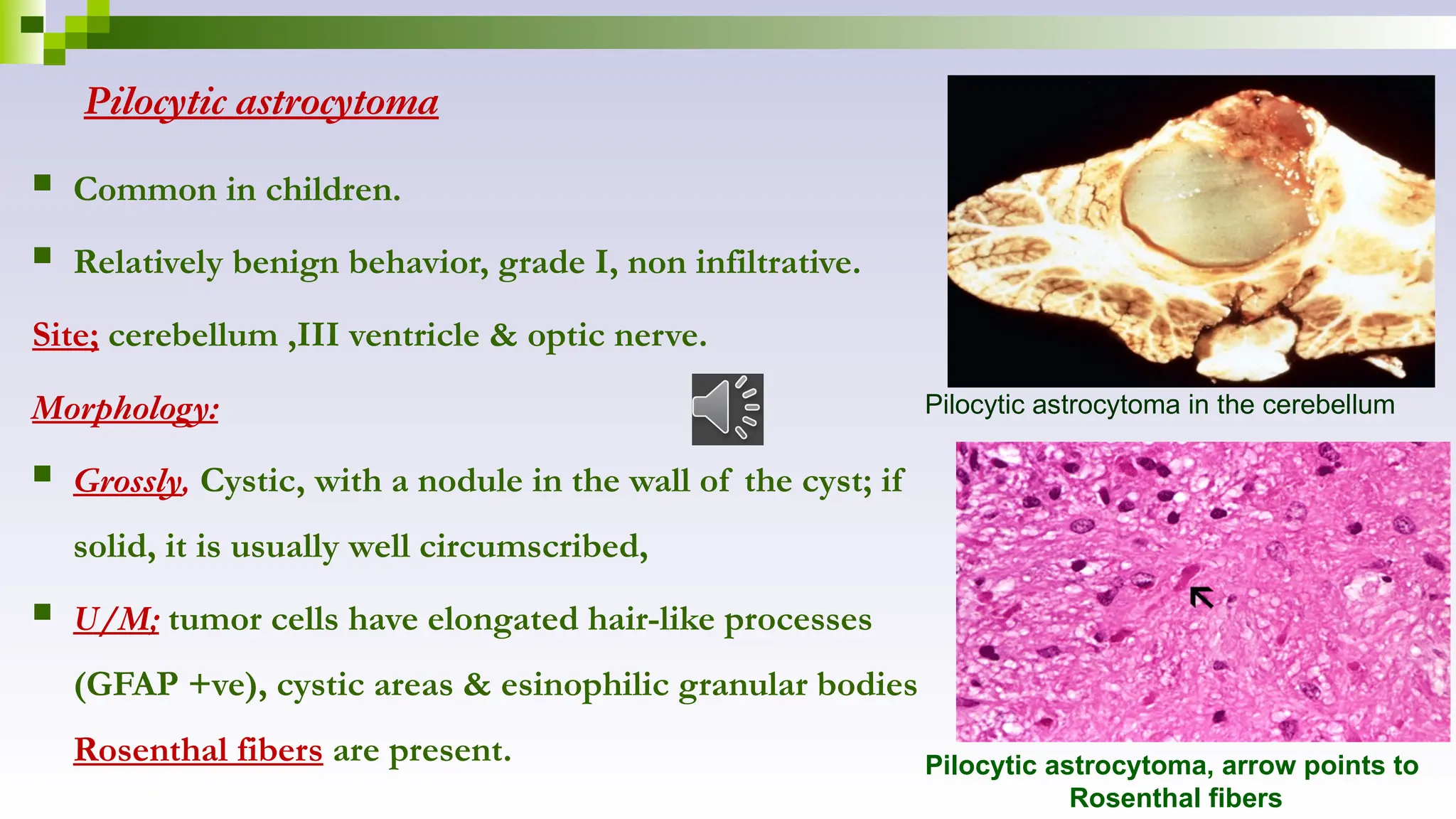 Pilocytic astrocytoma
 Common in children.
 Relatively benign behavior, grade I, non infiltrative.
Site; cerebellum ,III ventricle & optic nerve.
Morphology:
 Grossly, Cystic, with a nodule in the wall of the cyst; if
solid, it is usually well circumscribed,
 U/M; tumor cells have elongated hair-like processes
(GFAP +ve), cystic areas & esinophilic granular bodies
Rosenthal fibers are present. Pilocytic astrocytoma, arrow points to
Rosenthal fibers
Pilocytic astrocytoma in the cerebellum
 